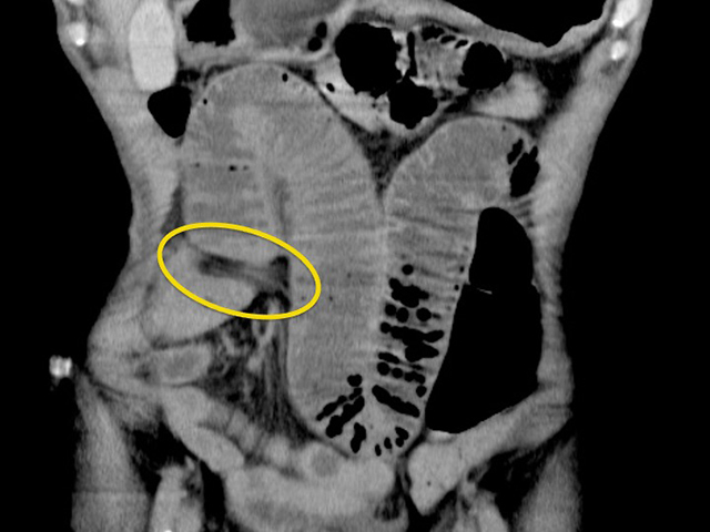 1年前に受けた開腹手術の際に生じた癒着により、ひも状の組織が生じてブリッジを形成、この中に小腸が入り込んで、腸閉塞をきたしている。