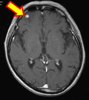 転移性脳腫瘍1