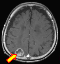 転移性脳腫瘍2