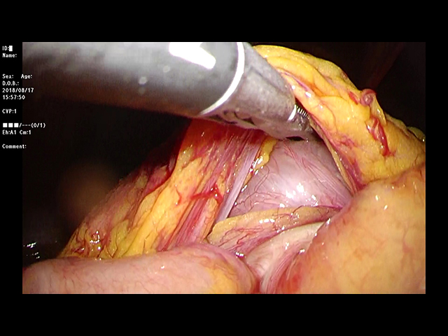 腹腔鏡で、3本のひも状の組織が小腸を締め付けている事を確認。