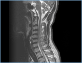 MRI脊髄画像