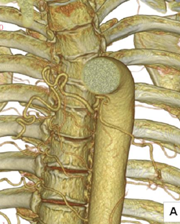 気管支動脈造影CT 3D